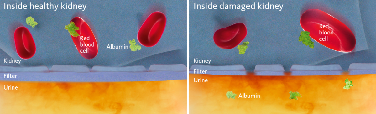 [.AT-de Austria (german)] Schematic and simplified view of a healthy and a damaged kidney membrane with the latter illustrating the cause of albuminuria.