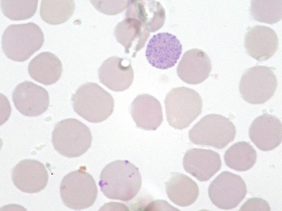 HbH-Zellen, Thalassämie
