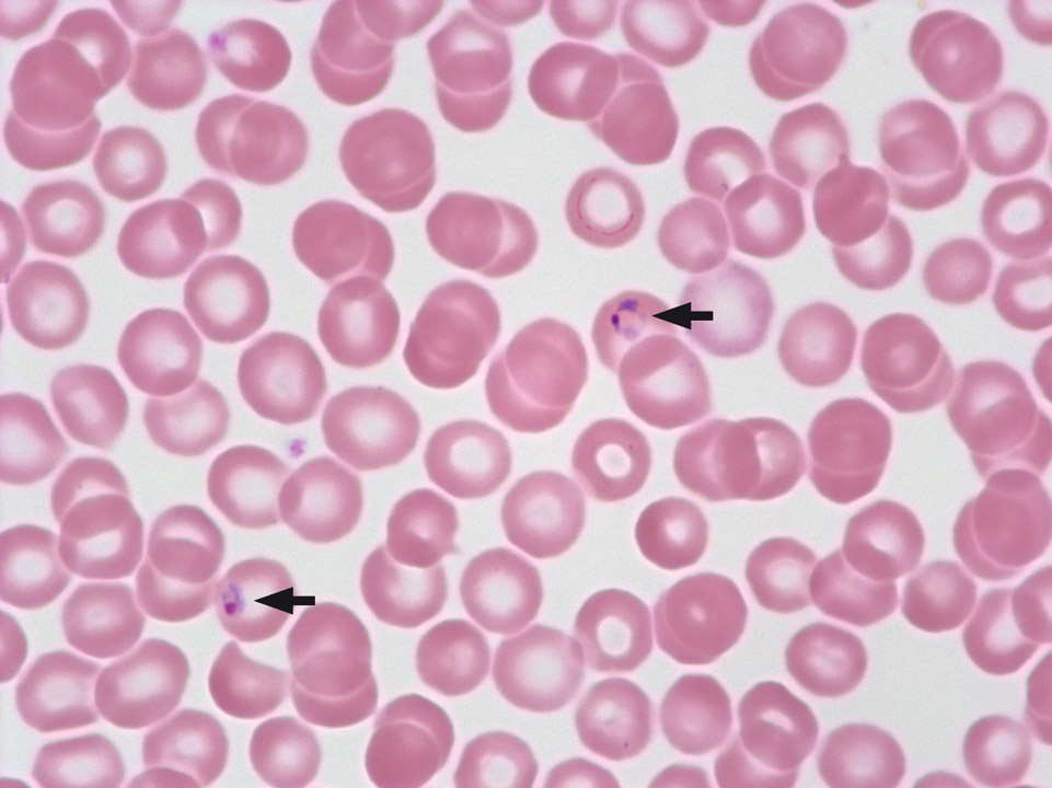 Plasmodium falciparum; Malaria