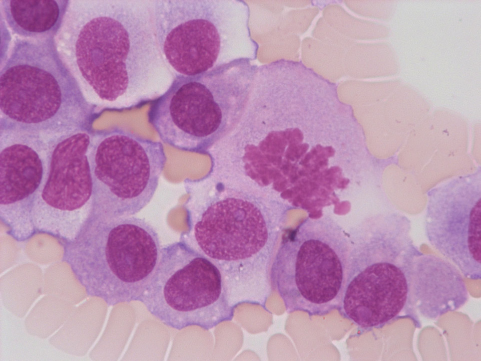 Zellen eines malignen Melanoms im Blutausstrich