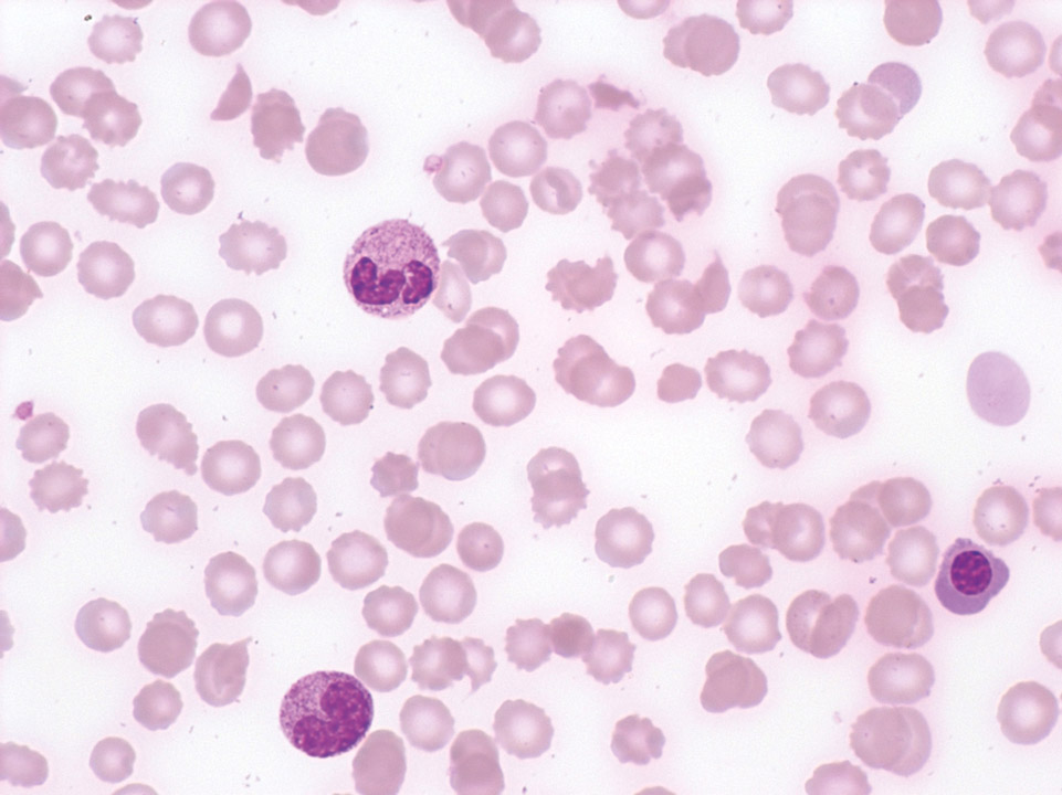 Leukoerythroblastisches Blutbild und Schistozyten