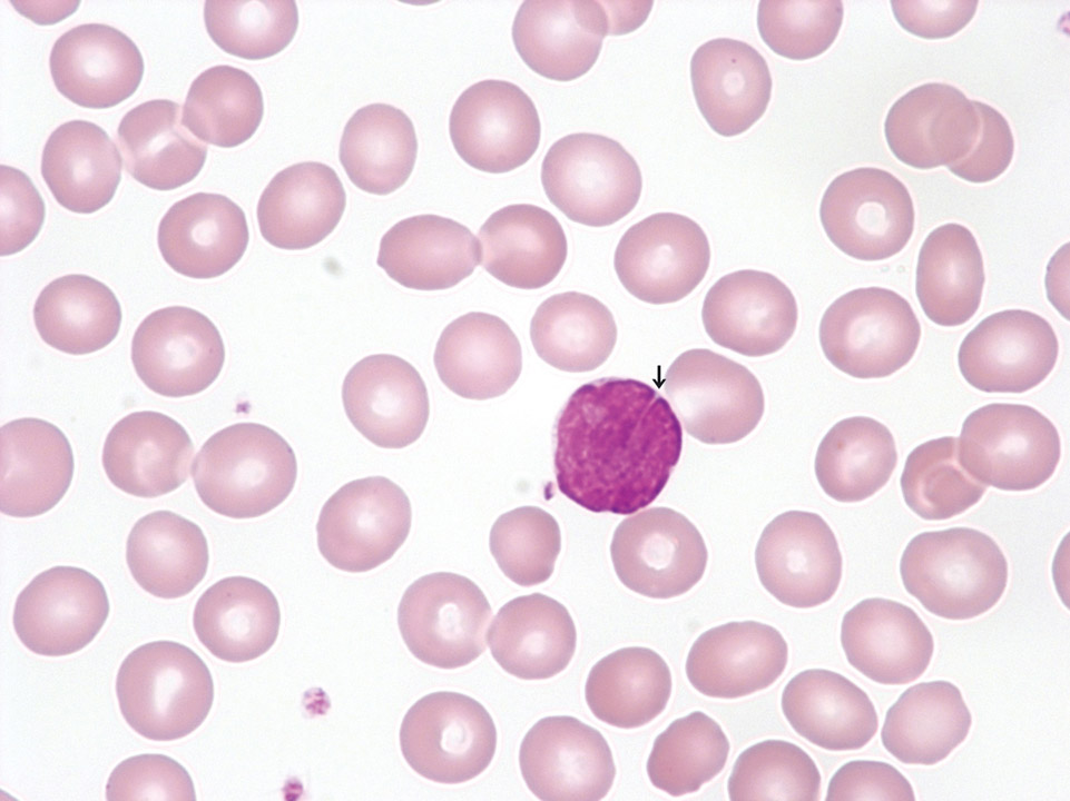Lymphomzellen im peripheren Blut