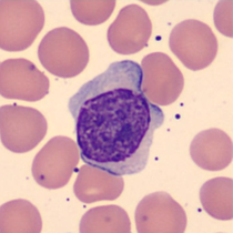Prolymphocyte