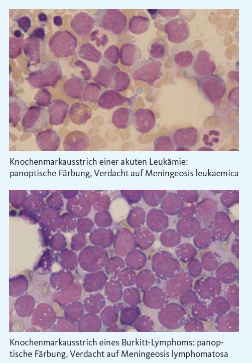 Erkenntnisse aus Knochenmark und Liquor