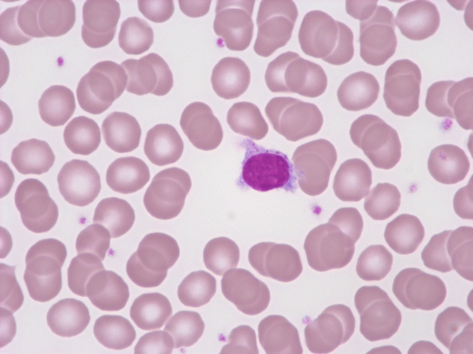 „Haariger“ Lymphozyt „Haariger“ Lymphozyt