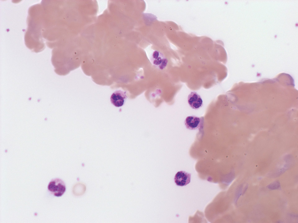 Agglutinierte Erythrozyten und ausgeprägte Polychromasie Agglutinierte Erythrozyten und ausgeprägte Polychromasie