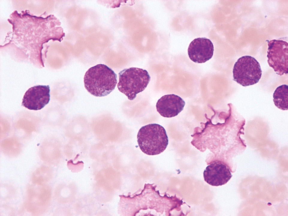 Akute T-lymphoblastische Leukämie (T-ALL) Akute T-lymphoblastische Leukämie (T-ALL)