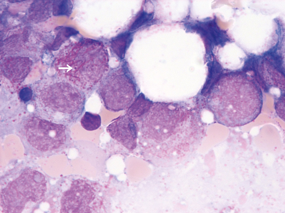 AML-Diagnose im Knochenmark AML-Diagnose im Knochenmark