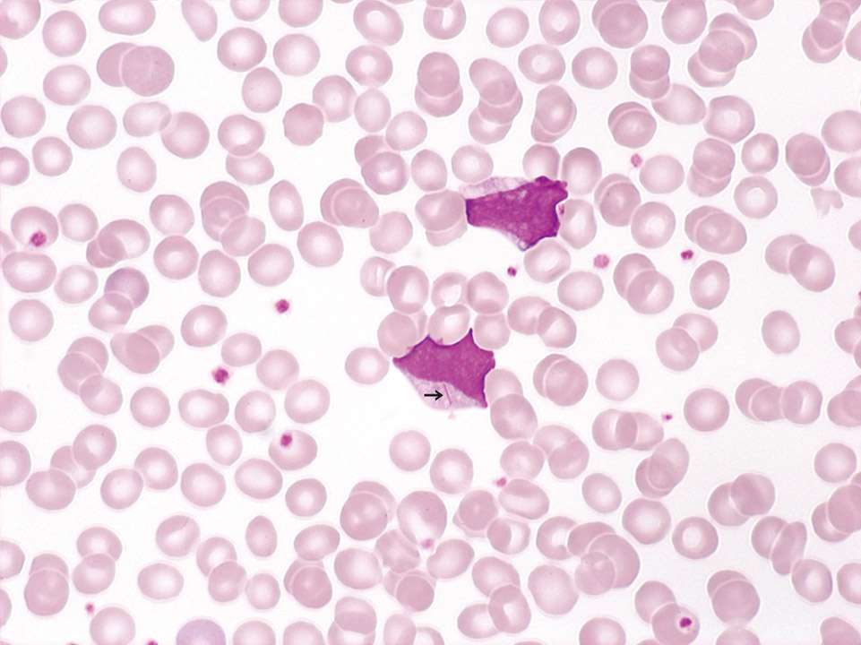 Akute myeloische Leukämie (AML) Akute myeloische Leukämie (AML)